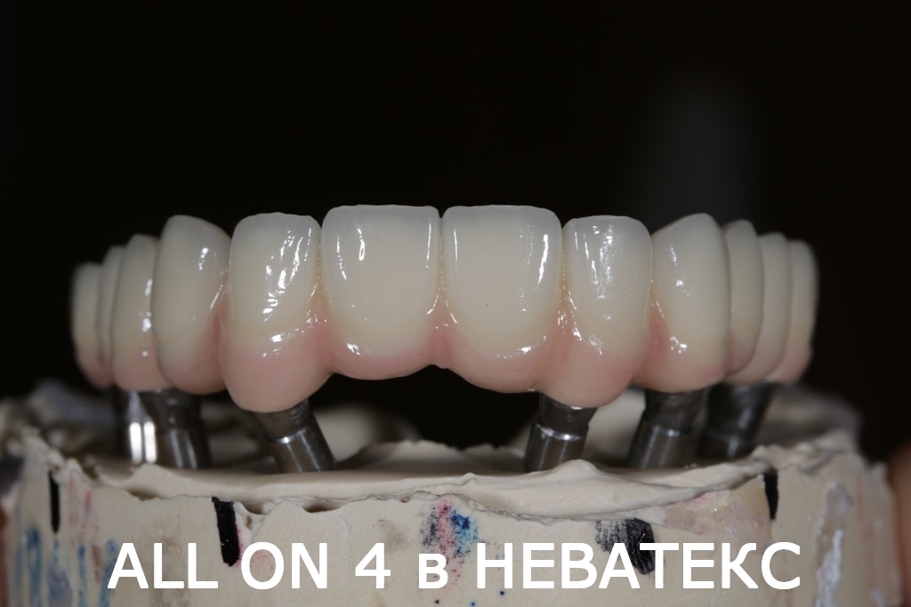 Восстановление утраченных зубов по технологии All on 6 all on 6